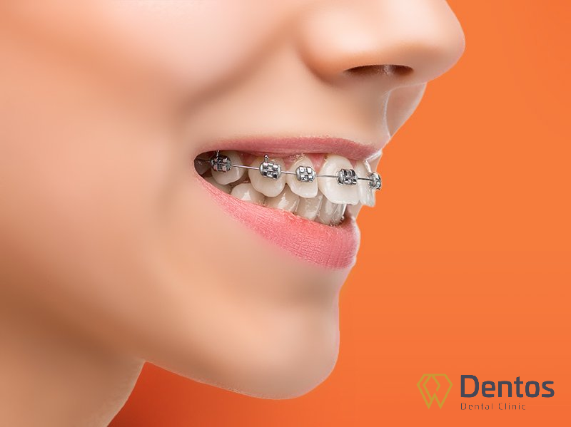 Răng mọc lệch lạc, sai khớp cắn thì niềng răng là giải pháp tận gốc